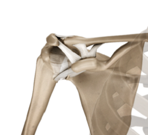 Acromioclavicular (AC) Joint Reconstruction