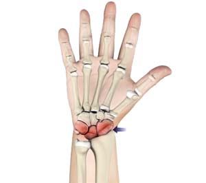 Arthritis of the Hand and Wrist