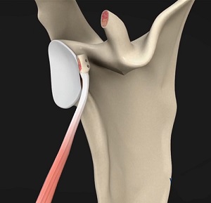 Latarjet Procedure