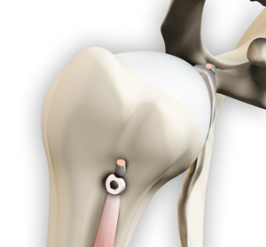 Proximal Biceps Tendon Rupture