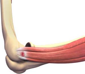 Lateral Epicondylitis / Tennis Elbow