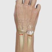 Wrist Fracture Fixation