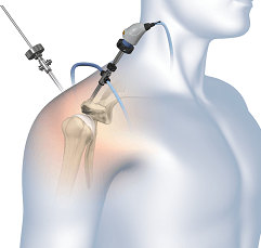 Arthroscopic Surgery